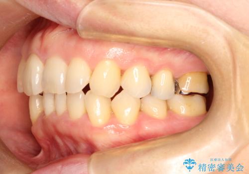 目立たないマウスピースで八重歯を解消。右上5番の抜歯スペースを活用したインビザライン矯正の治療前