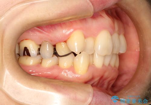 目立たないマウスピースで八重歯を解消。右上5番の抜歯スペースを活用したインビザライン矯正の治療前