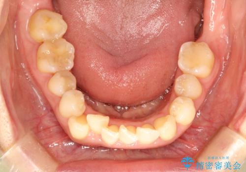 目立たないマウスピースで八重歯を解消。右上5番の抜歯スペースを活用したインビザライン矯正の治療前
