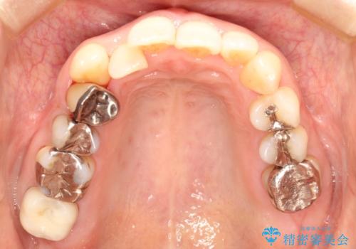 目立たないマウスピースで八重歯を解消。右上5番の抜歯スペースを活用したインビザライン矯正の治療前