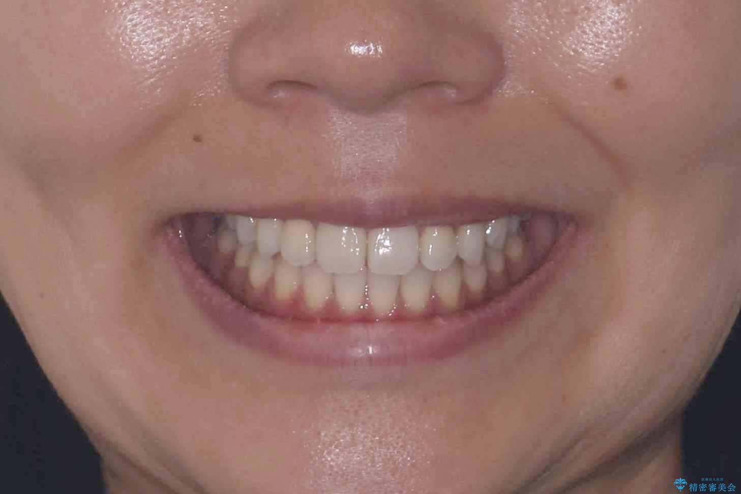 「歯を抜かずに、たった10ヵ月。」目立ちにくい大人の矯正の治療後(顔貌)