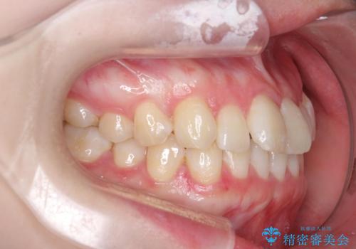 [ インビザラインライト ]  短期間で行う前歯のマウスピース治療の治療前
