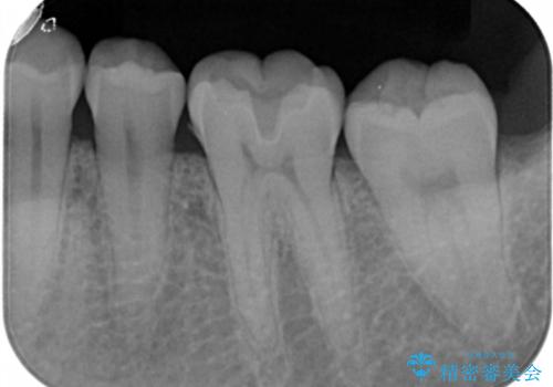 奥歯にセラミックを入れたい　セラミックインレーの治療前