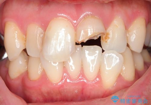 転んで折れた前歯セラミック治療で審美改善の治療前