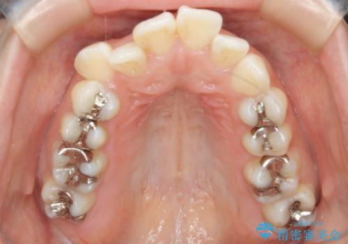 出っ歯が気になる　抜歯+ワイヤー矯正治療の治療前