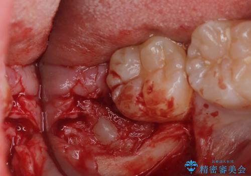 親知らず抜歯の治療中