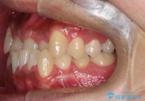 【ワイヤー矯正】かみ合わせを治したいの治療前