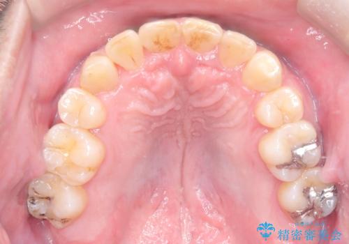 【ワイヤー矯正】かみ合わせを治したいの治療後