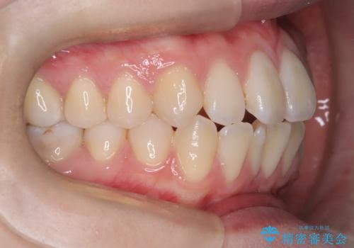 【ワイヤー矯正】前歯の突出感、下の歯の並びを良くしたいの治療前