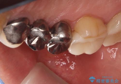 【セラミッククラウン】歯が欠けた!の治療前