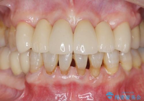 [ 全て歯を抜かなければいけないと言われた] 矯正治療を含む包括的歯周病治療の治療後