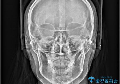「歯を抜かずに、たった10ヵ月。」目立ちにくい大人の矯正の治療後