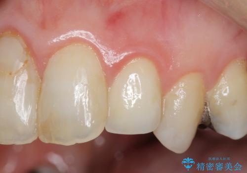 [ ジルコニアセラミッククラウン] 神経の死んだ前歯の治療の症例 治療後