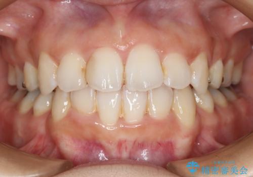 出っ歯が気になる　抜歯+ワイヤー矯正治療