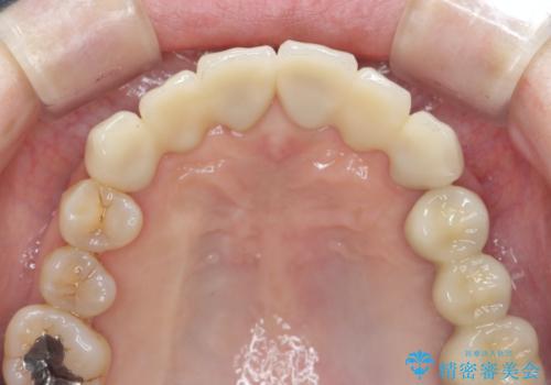 [ 全て歯を抜かなければいけないと言われた] 矯正治療を含む包括的歯周病治療の治療後