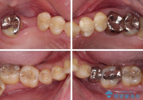 かかりつけ医の治療方針に疑問 歯周病治療と矯正治療を合わせた総合歯科治療の治療前