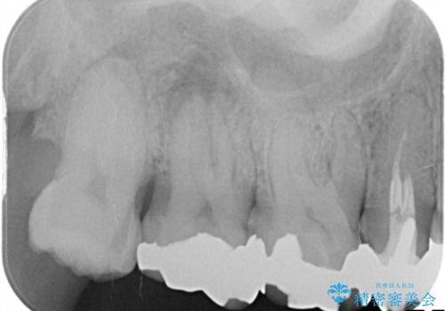 銀歯からセラミックへ。右上奥歯の精密根管治療と審美修復の治療前