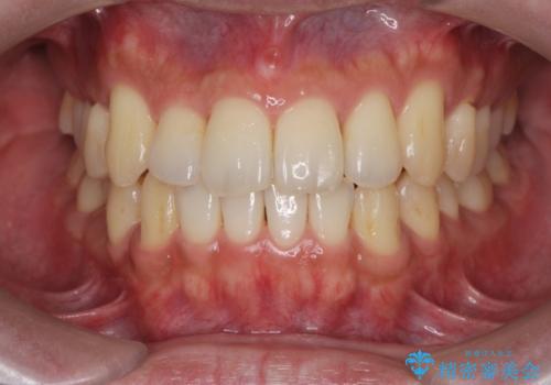 [ インビザライン矯正 ]  マウスピースで治す、すきっ歯　がたつきの治療後