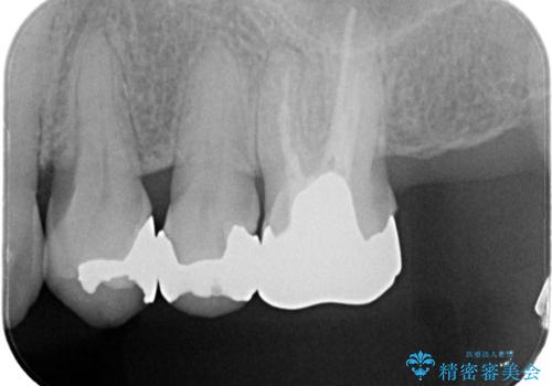 銀歯を自然な白さに。左上小臼歯2本のセラミックインレー修復の治療前