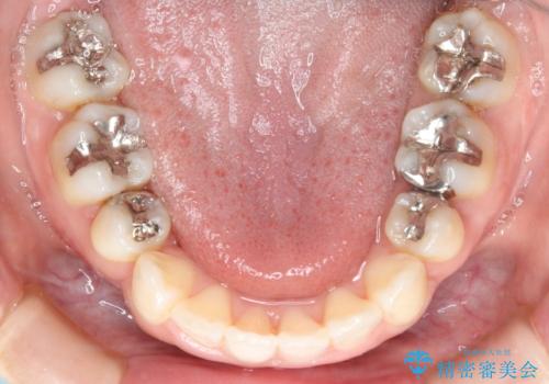 出っ歯が気になる 抜歯+ワイヤー矯正治療の治療後