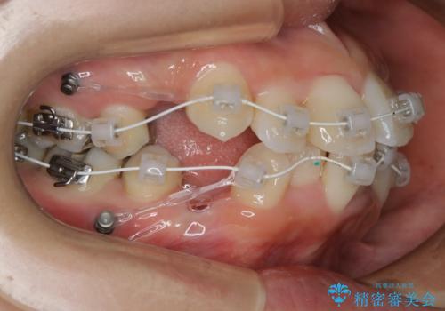 出っ歯が気になる　抜歯+ワイヤー矯正治療の治療中