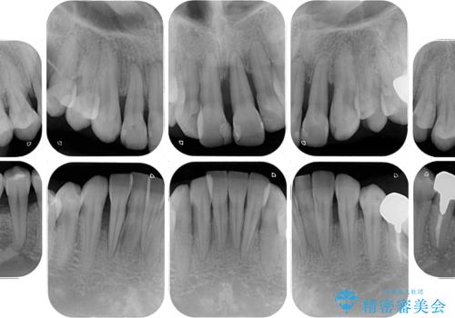 かかりつけ医の治療方針に疑問　歯周病治療と矯正治療を合わせた総合歯科治療の治療前