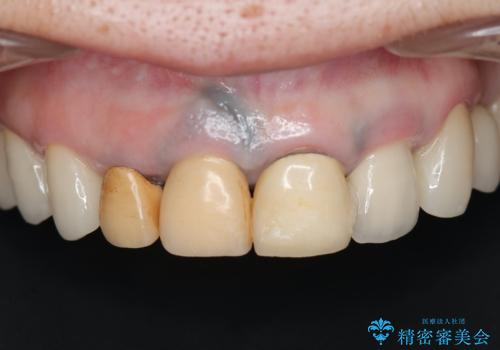 保険適応 硬質レジン前装冠から審美的でオールセラミッククラウンへの治療前