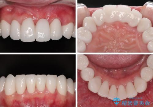 かかりつけ医の治療方針に疑問　歯周病治療と矯正治療を合わせた総合歯科治療の治療後