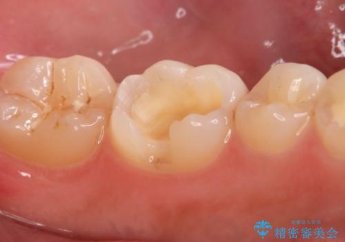 奥歯にセラミックを入れたい セラミックインレーの治療中