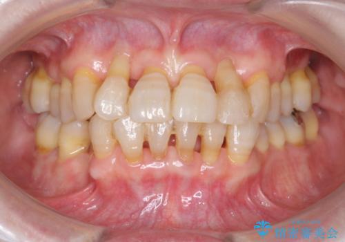 [ 全て歯を抜かなければいけないと言われた] 矯正治療を含む包括的歯周病治療の治療前