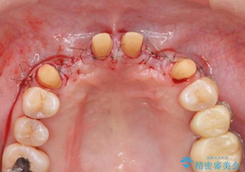 [ 全て歯を抜かなければいけないと言われた] 矯正治療を含む包括的歯周病治療の治療中