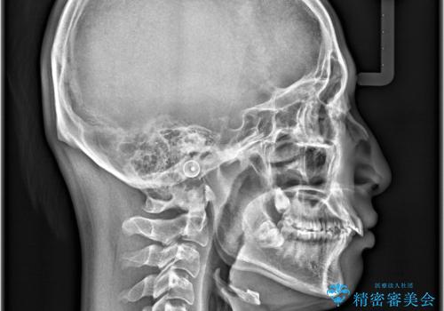 デコボコも深いかみ合わせも…“全部気になる”を一気に解決の治療前