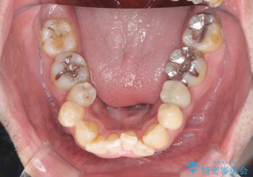 全ての銀歯を外すメタルフリー治療 + 歯並びをきれいにする矯正治療の治療前