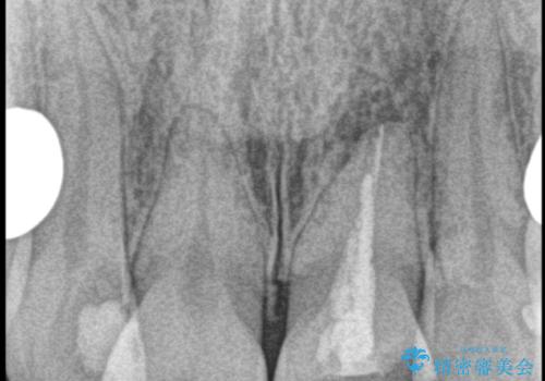 転んで折れた前歯セラミック治療で審美改善の治療前