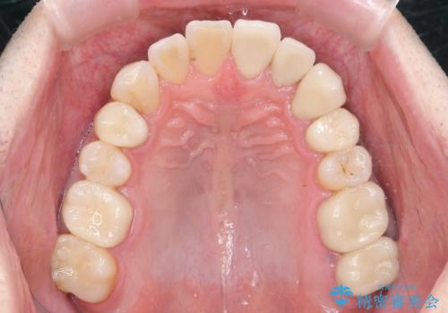 全ての銀歯を外すメタルフリー治療 + 歯並びをきれいにする矯正治療の治療後