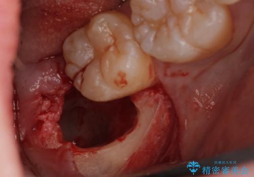 親知らず抜歯の治療中