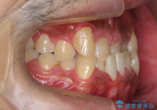 【ワイヤー矯正】かみ合わせを治したいの治療前