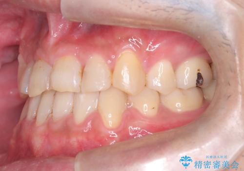 【ワイヤー矯正】かみ合わせを治したいの治療後