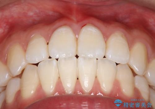 【ワイヤー矯正】前歯の突出感、下の歯の並びを良くしたいの治療後