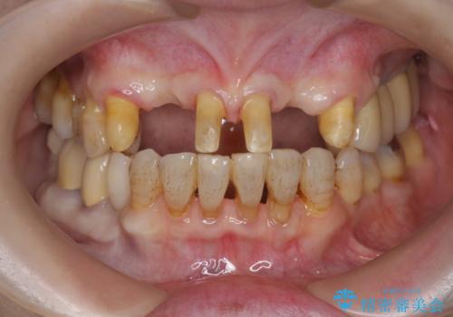 [ 全て歯を抜かなければいけないと言われた] 矯正治療を含む包括的歯周病治療の治療中