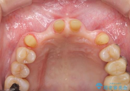 [ 全て歯を抜かなければいけないと言われた] 矯正治療を含む包括的歯周病治療の治療中