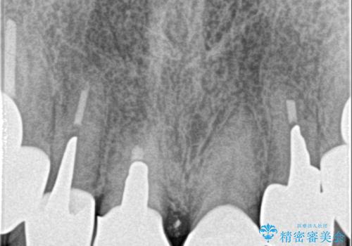 保険適応 硬質レジン前装冠から審美的でオールセラミッククラウンへの治療後