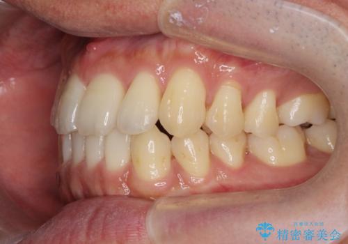 [ インビザライン矯正 ]  マウスピースで治す、すきっ歯　がたつきの治療後