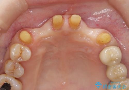 [ 全て歯を抜かなければいけないと言われた] 矯正治療を含む包括的歯周病治療の治療中