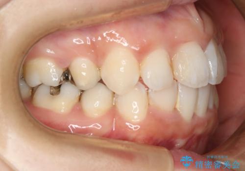 出っ歯が気になる　抜歯+ワイヤー矯正治療の治療後