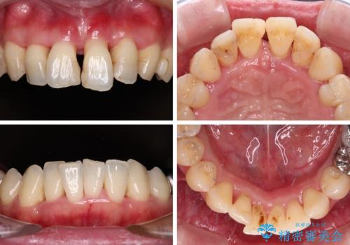 かかりつけ医の治療方針に疑問 歯周病治療と矯正治療を合わせた総合歯科治療の治療前
