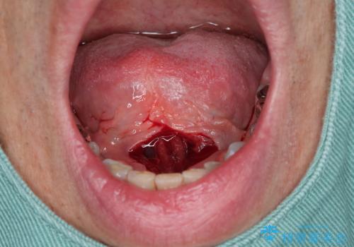 『舌小帯形成術』 ベロの動きを良くして滑舌を改善したいの治療中