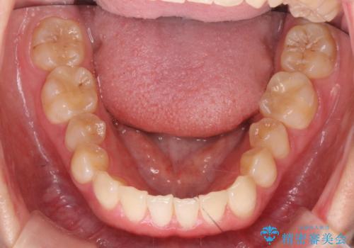 [ インビザラインライト ]  短期間で行う前歯のマウスピース治療の治療後