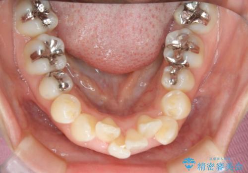 出っ歯が気になる　抜歯+ワイヤー矯正治療の治療前