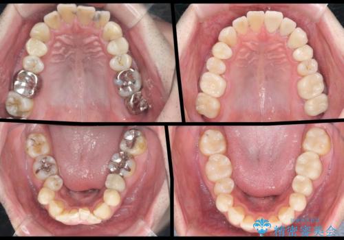 全ての銀歯を外すメタルフリー治療 + 歯並びをきれいにする矯正治療